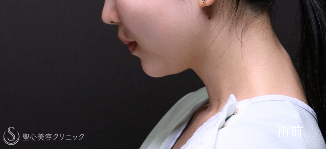 【30代女性・脂肪吸引で顎下にくびれを】ベイザーリポ2.2脂肪吸引（術後6ヶ月） Before 