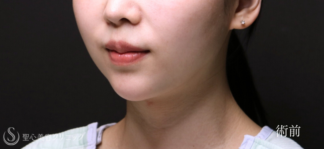 【30代女性・脂肪吸引で顎下にくびれを】ベイザーリポ2.2脂肪吸引（術後6ヶ月） Before 