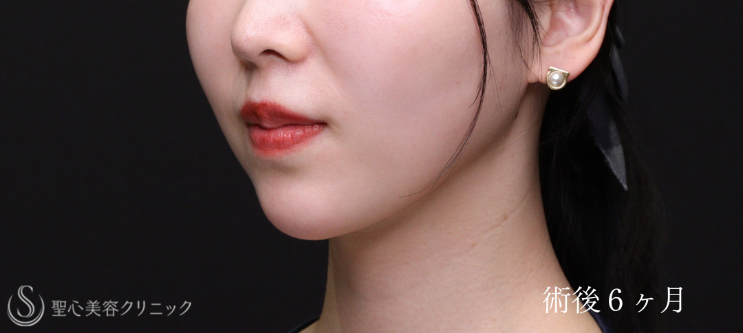 【30代女性・脂肪吸引で顎下にくびれを】ベイザーリポ2.2脂肪吸引（術後6ヶ月） After 