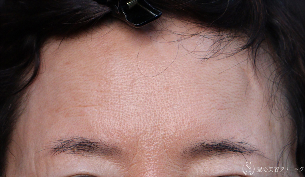 【50代女性・額の傷痕としわを浅く】プレミアムPRP皮膚再生療法（術後7ヶ月） After 