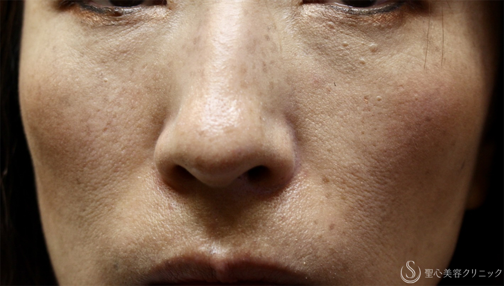 【42歳→50歳女性・肌育で若返り】プレミアムPRP皮膚再生療法（8年後） Before 
