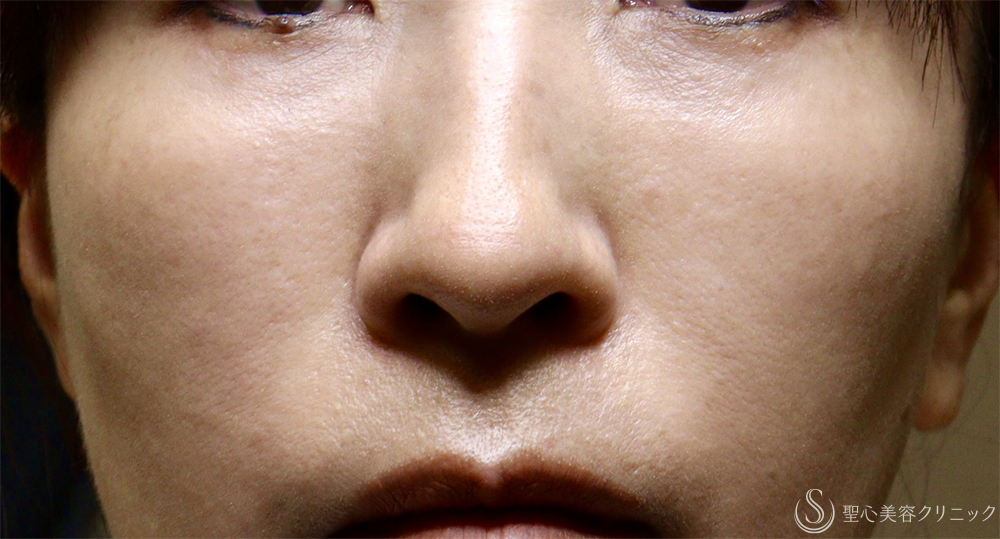 【42歳→50歳女性・肌育で若返り】プレミアムPRP皮膚再生療法（8年後） After 