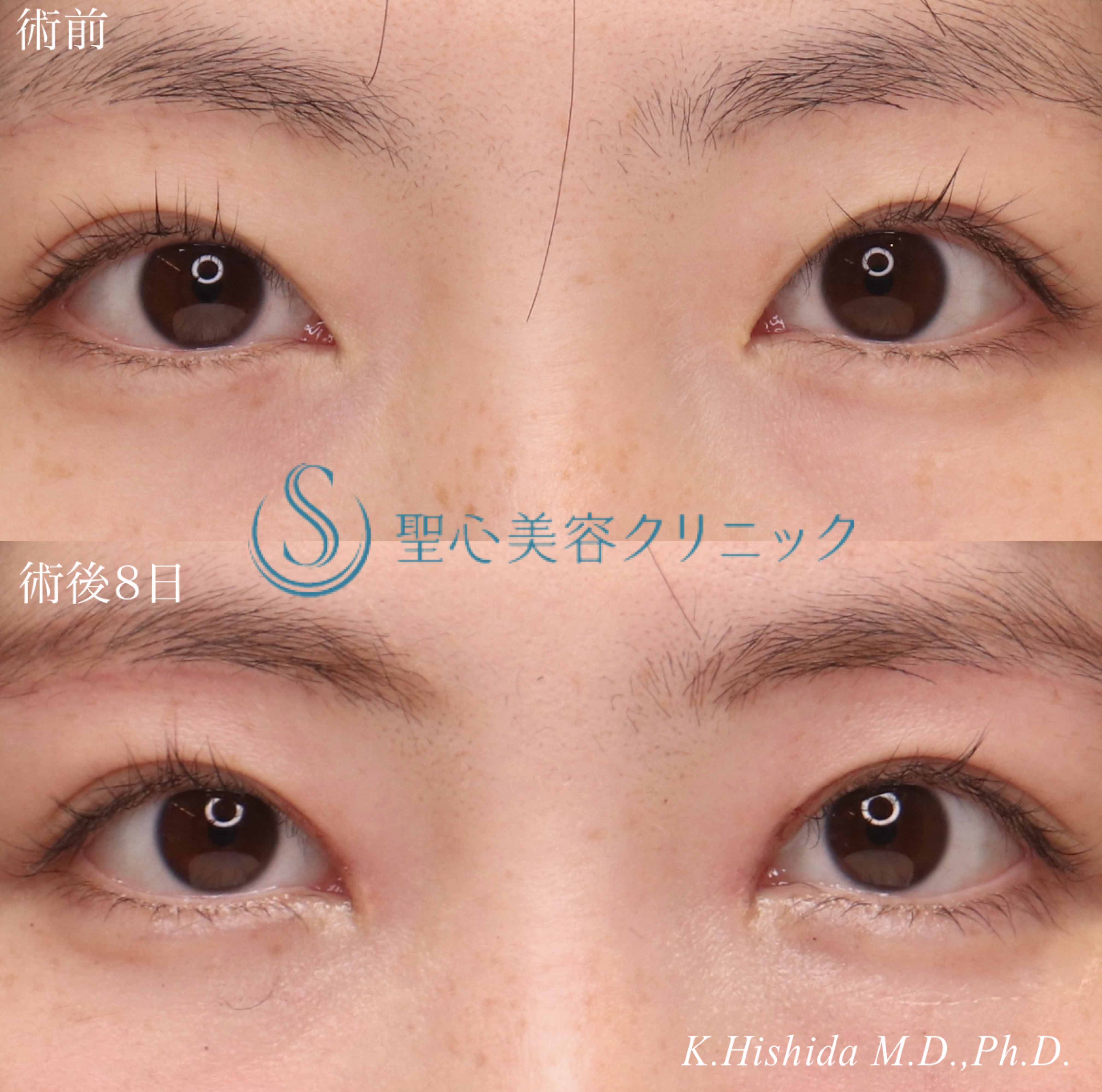 【30代女性・寄り目にさせず蒙古襞を解除したい！！】目上切開（8日後・抜糸時） After 