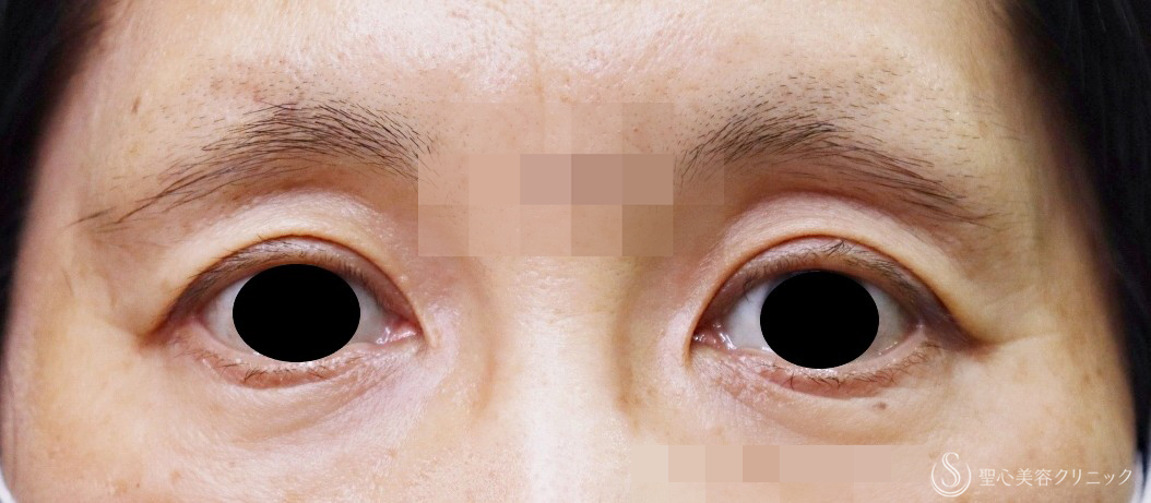 【50代女性・目の上のくぼみ】プレミアムPRP皮膚再生療法（術後5年） Before 