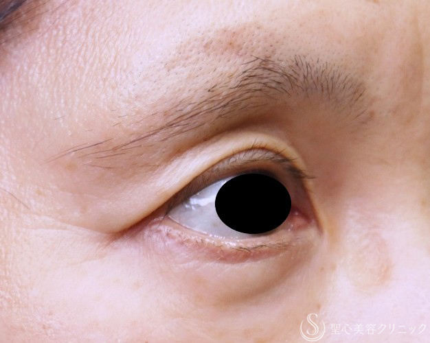 【50代女性・目の上のくぼみ】プレミアムPRP皮膚再生療法（術後5年） Before 