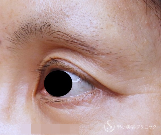 【50代女性・目の上のくぼみ】プレミアムPRP皮膚再生療法（術後5年） Before 