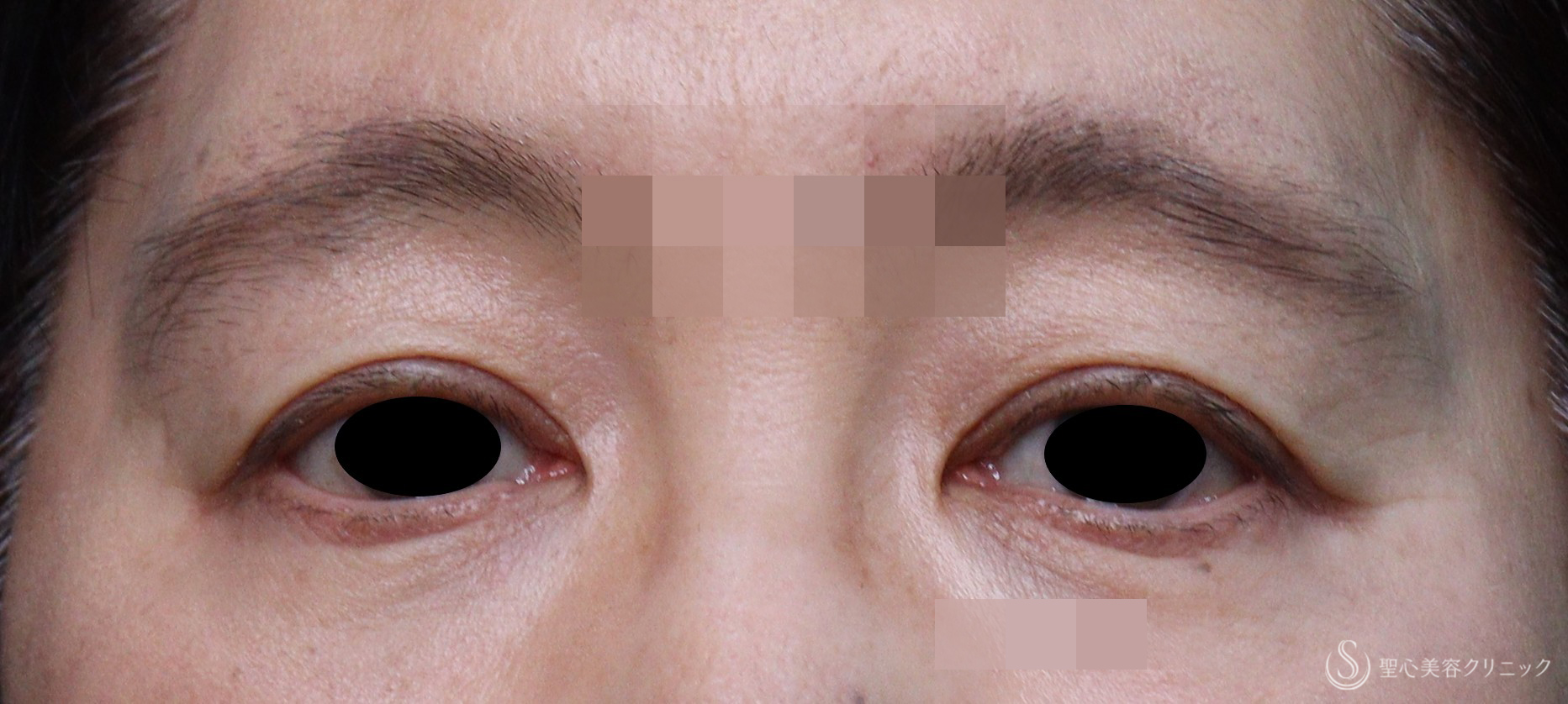 【50代女性・目の上のくぼみ】プレミアムPRP皮膚再生療法（術後5年） After 