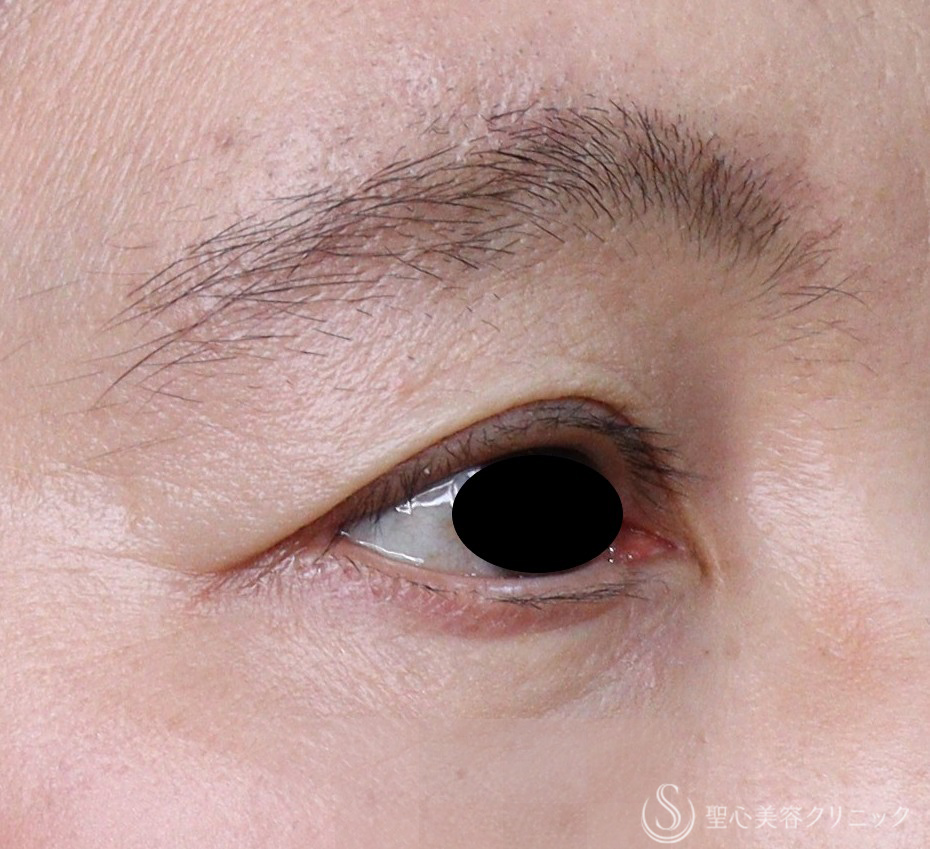 【50代女性・目の上のくぼみ】プレミアムPRP皮膚再生療法（術後5年） After 