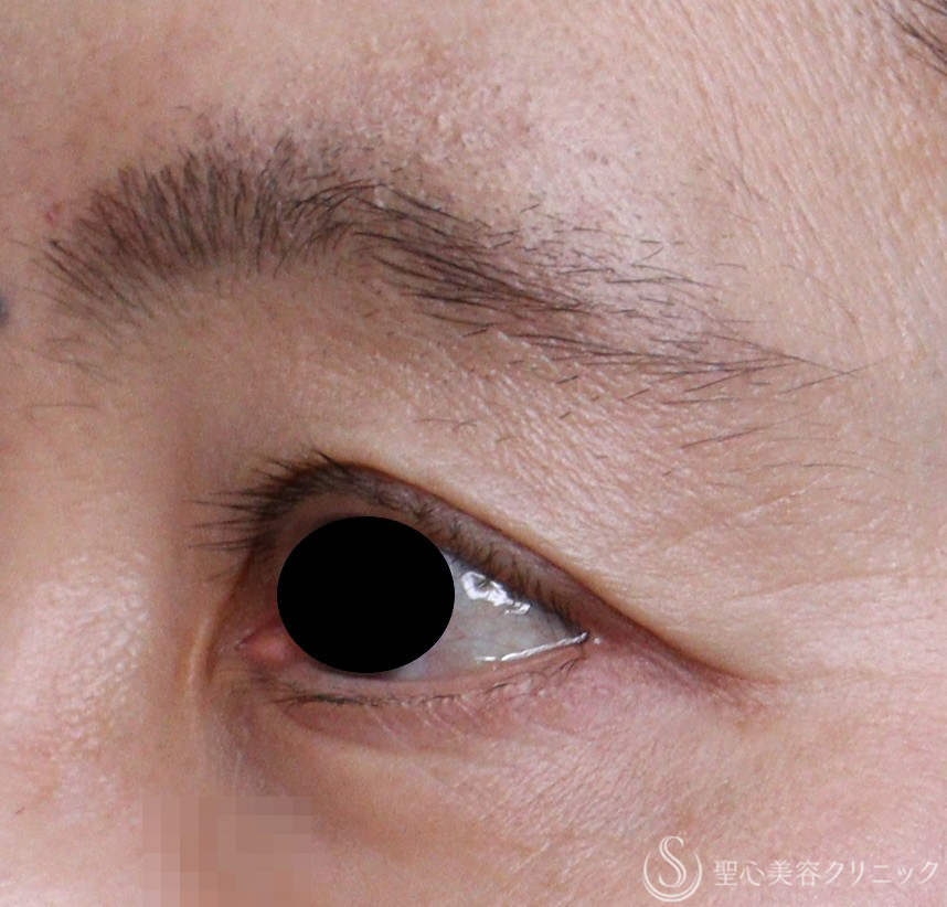 【50代女性・目の上のくぼみ】プレミアムPRP皮膚再生療法（術後5年） After 