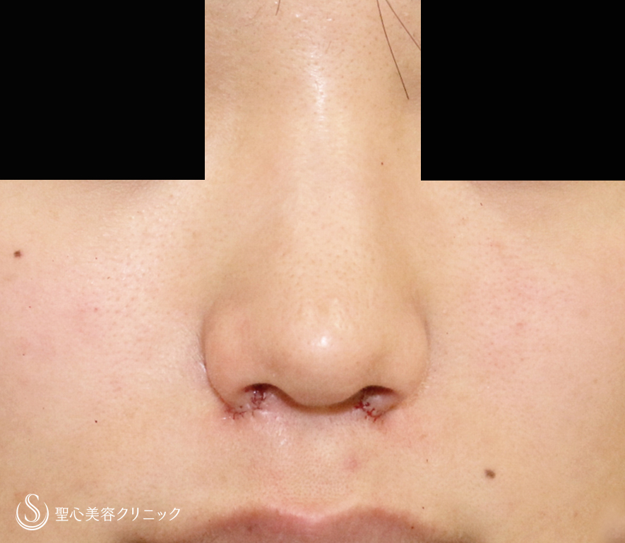 【難易度「特級」忘れ鼻をつくる】小鼻縮小術+α法「Ver.7.5」（直後〜1ヶ月後） Before 