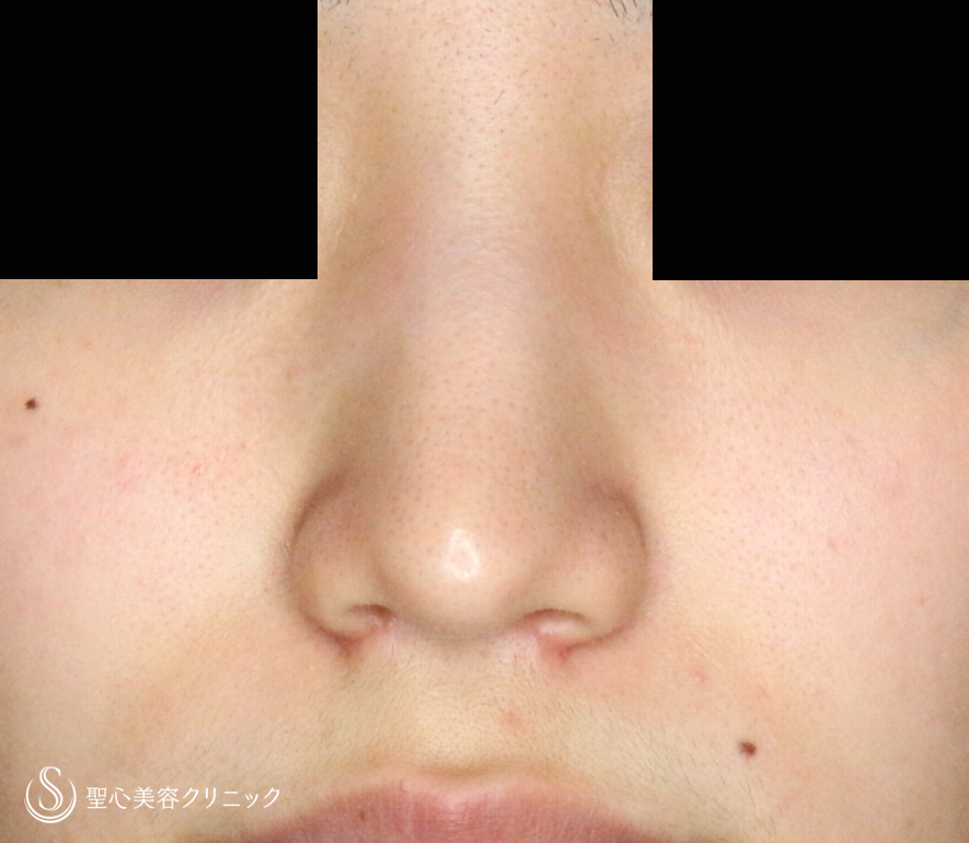 【難易度「特級」忘れ鼻をつくる】小鼻縮小術+α法「Ver.7.5」（直後〜1ヶ月後） After 