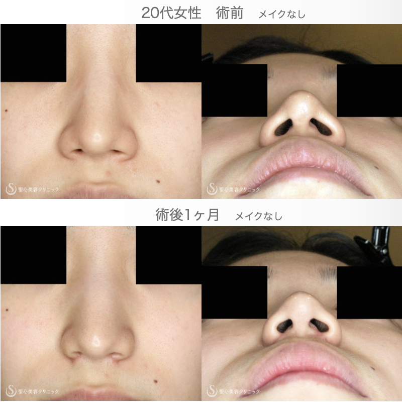 【難易度「特級」忘れ鼻をつくる】小鼻縮小術+α法「Ver.7.5」（直後〜1ヶ月後） After 
