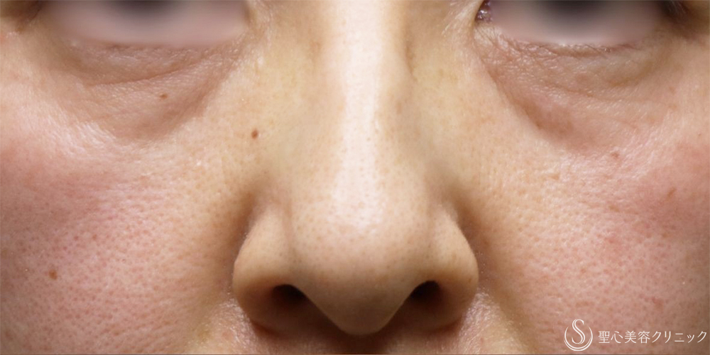 【50代女性・目の下のへこみが改善】プレミアムPRP皮膚再生療法（目の下）（術後6ヶ月～6年後） Before 