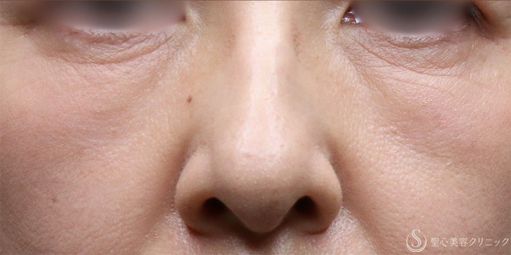 【50代女性・目の下のへこみが改善】プレミアムPRP皮膚再生療法（目の下）（術後6ヶ月～6年後） After 