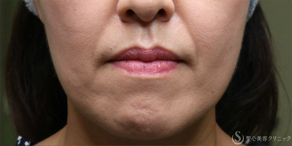 【50代女性・自然な若返り】プレミアムPRP皮膚再生療法（法令線・マリオネットライン）（5年後） Before 