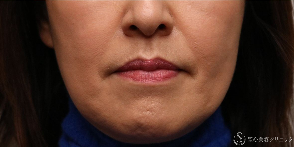 【50代女性・自然な若返り】プレミアムPRP皮膚再生療法（法令線・マリオネットライン）（5年後） After 