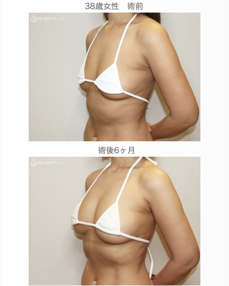 【38歳女性・脂肪幹細胞豊胸】プレミアムセリューション豊胸術（6ヶ月後） After 