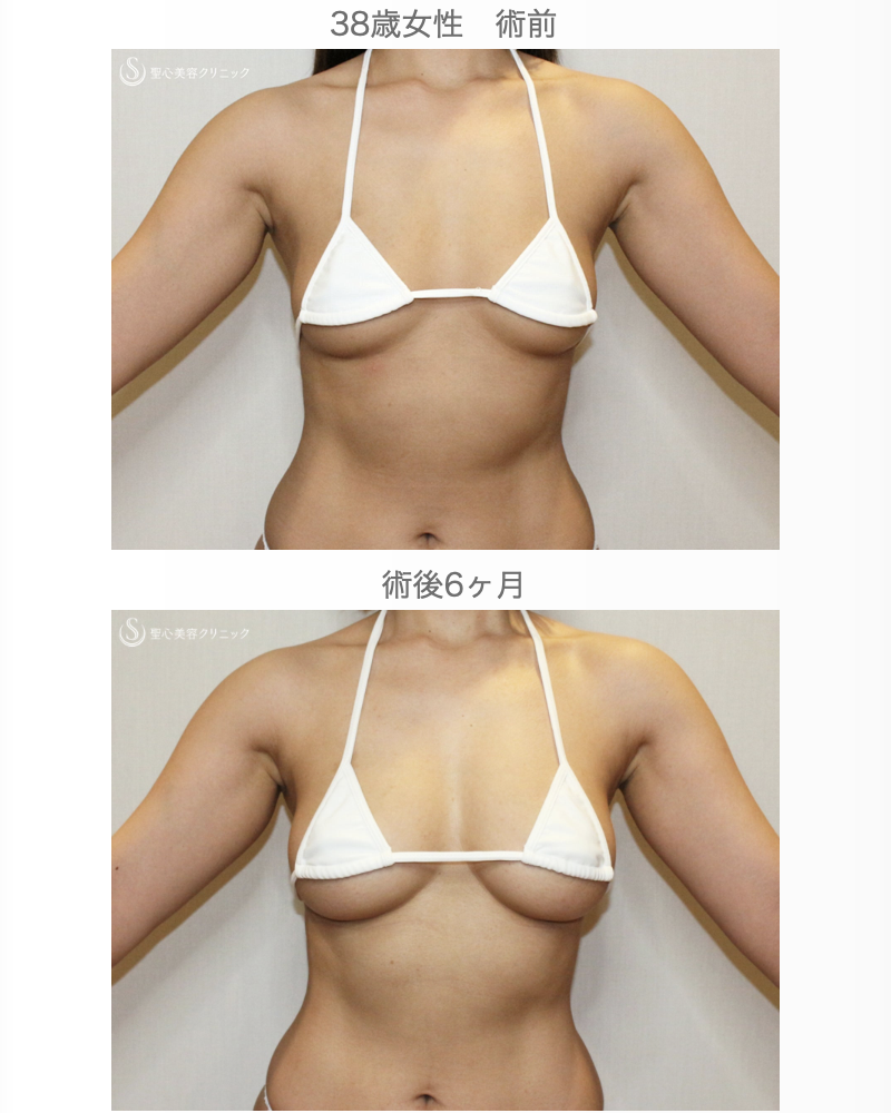【38歳女性・脂肪幹細胞豊胸】プレミアムセリューション豊胸術（6ヶ月後） After 
