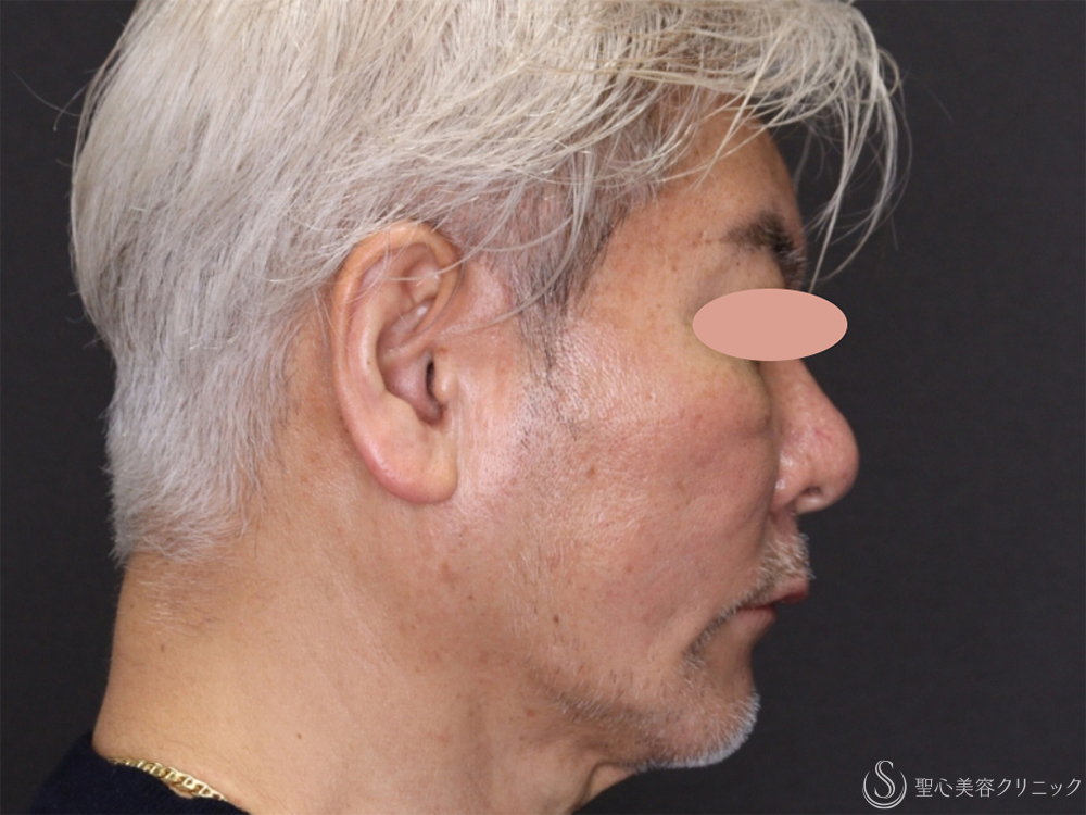 【60代男性・フェイスラインがスッキリ】アンカーDXダブル（バイニードル）（術後1ヶ月） After 