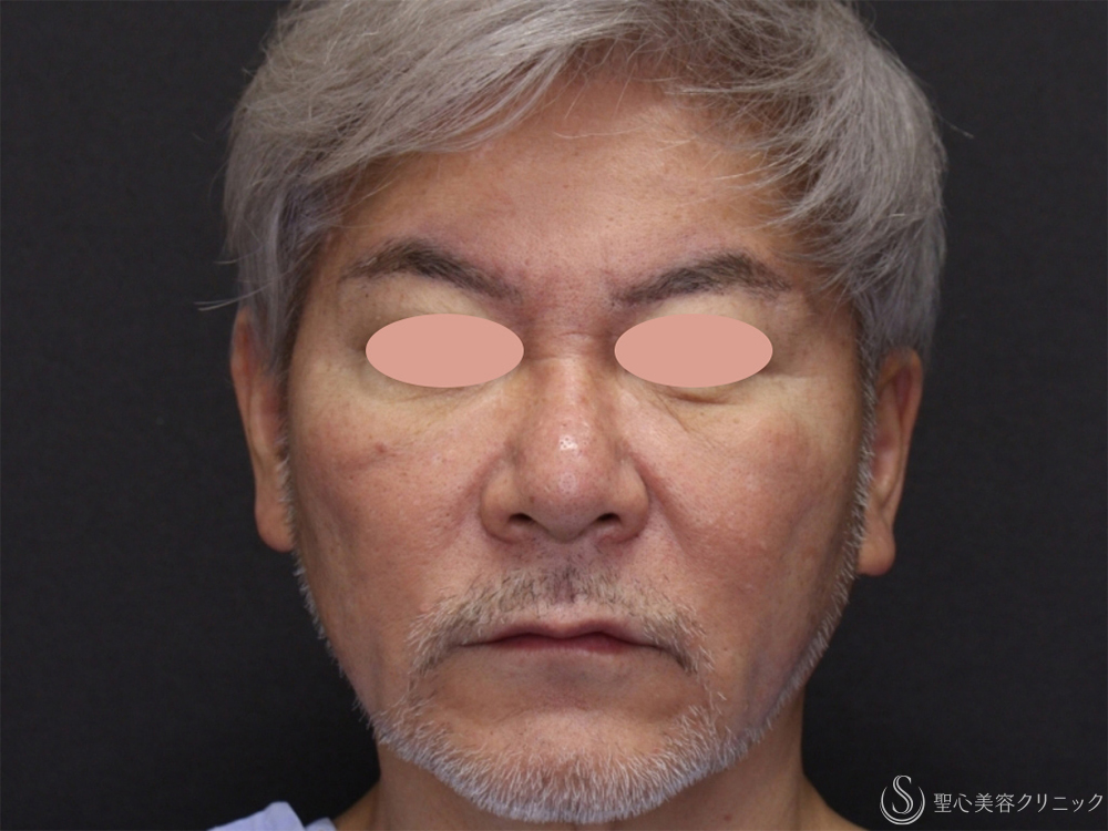 アンカーDXダブル_Before