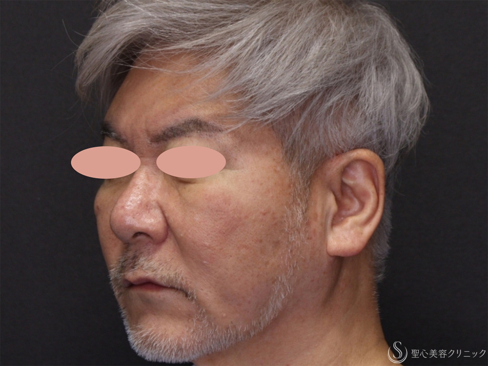 【60代男性・フェイスラインがスッキリ】アンカーDXダブル（バイニードル）（術後1ヶ月） Before 