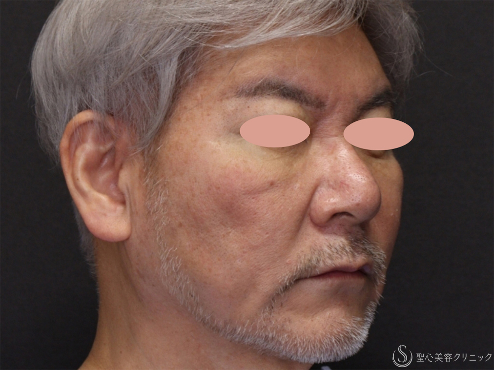 【60代男性・フェイスラインがスッキリ】アンカーDXダブル（バイニードル）（術後1ヶ月） Before 