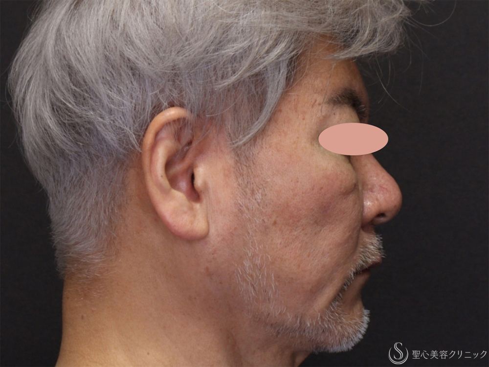 【60代男性・フェイスラインがスッキリ】アンカーDXダブル（バイニードル）（術後1ヶ月） Before 