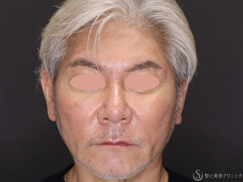 アンカーDXダブル_After