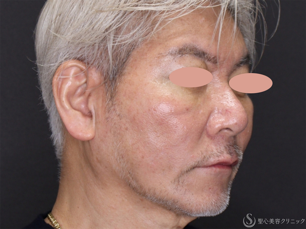 【60代男性・フェイスラインがスッキリ】アンカーDXダブル（バイニードル）（術後1ヶ月） After 