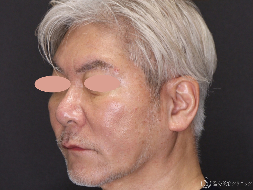 【60代男性・フェイスラインがスッキリ】アンカーDXダブル（バイニードル）（術後1ヶ月） After 
