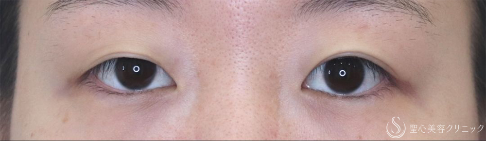 【20代女性・腫れが少なく自然な仕上がり】二重術（切開法）部分切開/全切開＋眼窩脱脂（術後2日～1ヶ月後） Before 