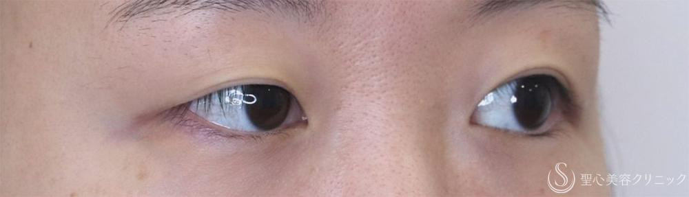 【20代女性・腫れが少なく自然な仕上がり】二重術（切開法）部分切開/全切開＋眼窩脱脂（術後2日～1ヶ月後） Before 