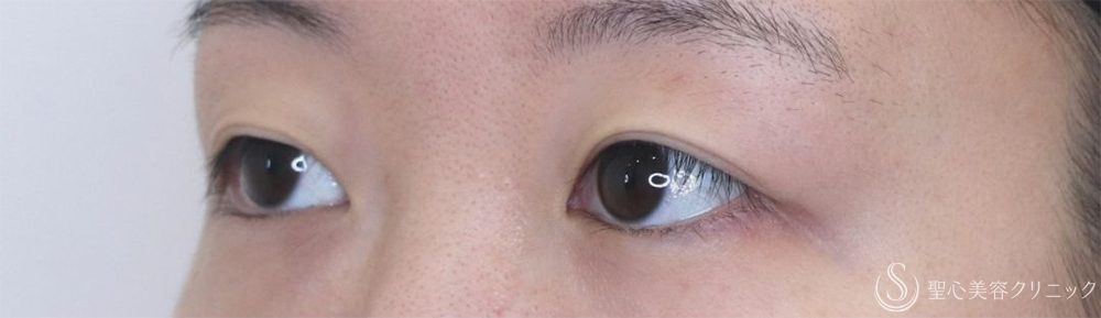 【20代女性・腫れが少なく自然な仕上がり】二重術（切開法）部分切開/全切開＋眼窩脱脂（術後2日～1ヶ月後） Before 