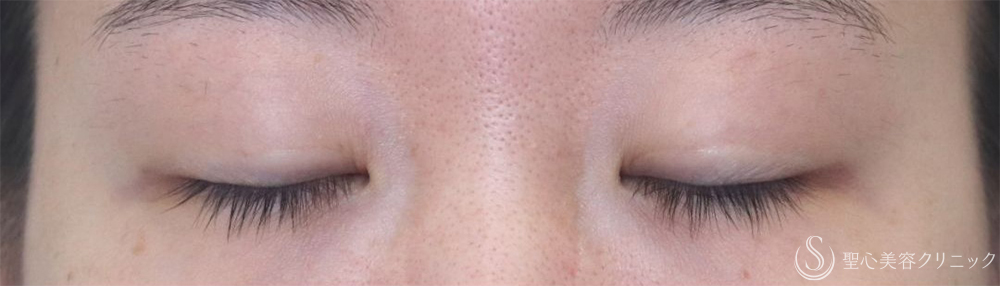 【20代女性・腫れが少なく自然な仕上がり】二重術（切開法）部分切開/全切開＋眼窩脱脂（術後2日～1ヶ月後） Before 