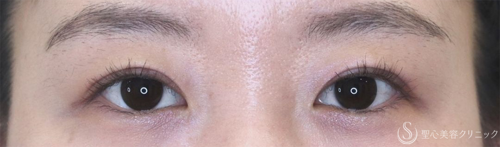 【20代女性・腫れが少なく自然な仕上がり】二重術（切開法）部分切開/全切開＋眼窩脱脂（術後2日～1ヶ月後） After 
