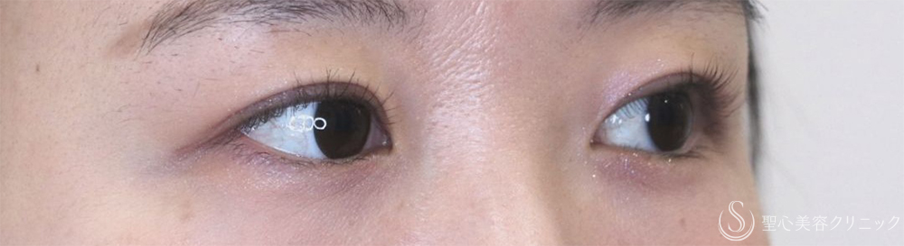 【20代女性・腫れが少なく自然な仕上がり】二重術（切開法）部分切開/全切開＋眼窩脱脂（術後2日～1ヶ月後） After 