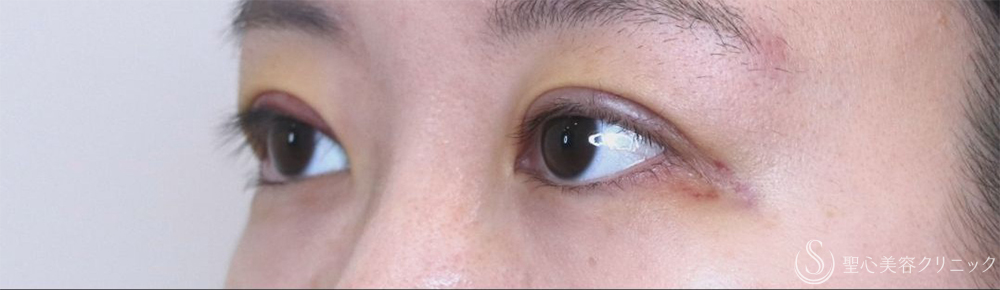 【20代女性・腫れが少なく自然な仕上がり】二重術（切開法）部分切開/全切開＋眼窩脱脂（術後2日～1ヶ月後） After 