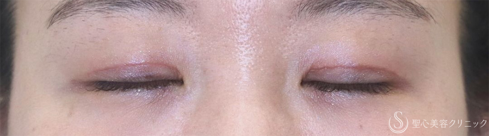 【20代女性・腫れが少なく自然な仕上がり】二重術（切開法）部分切開/全切開＋眼窩脱脂（術後2日～1ヶ月後） After 