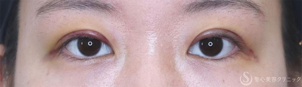 【20代女性・腫れが少なく自然な仕上がり】二重術（切開法）部分切開/全切開＋眼窩脱脂（術後2日～1ヶ月後） After 