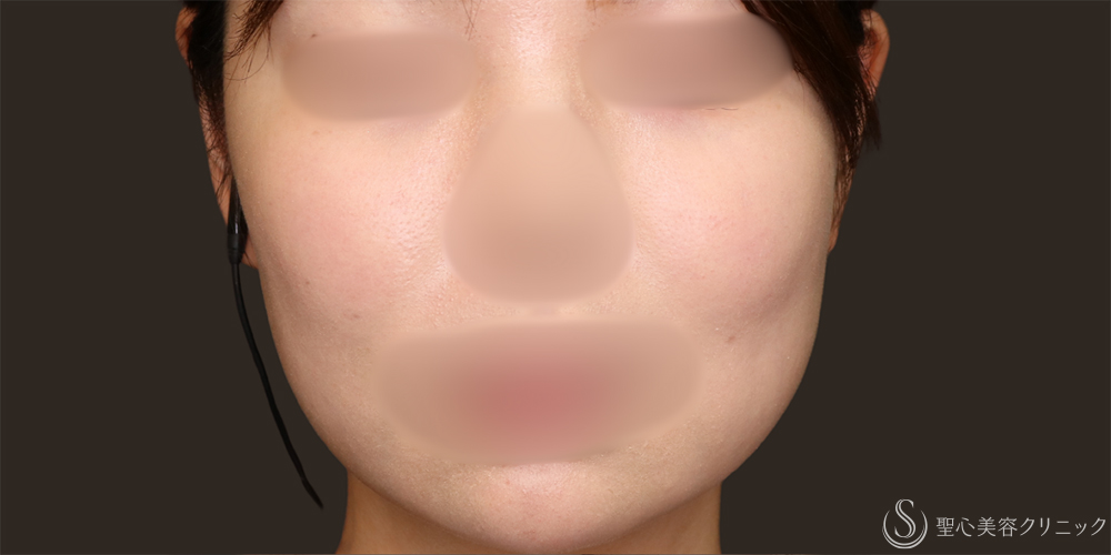 【20代女性・マシンでフェイスラインスッキリ】ドクターハイフ（ウルトラセル[zíː]）（2回）（3ヶ月後） Before 