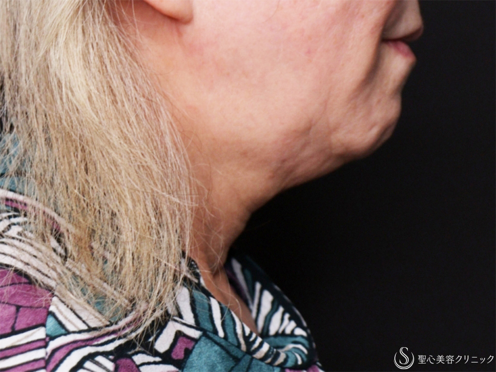 肌育スレッド（フィオラ スレッド PDRN モノ）＋顎ボトックス注入_Before