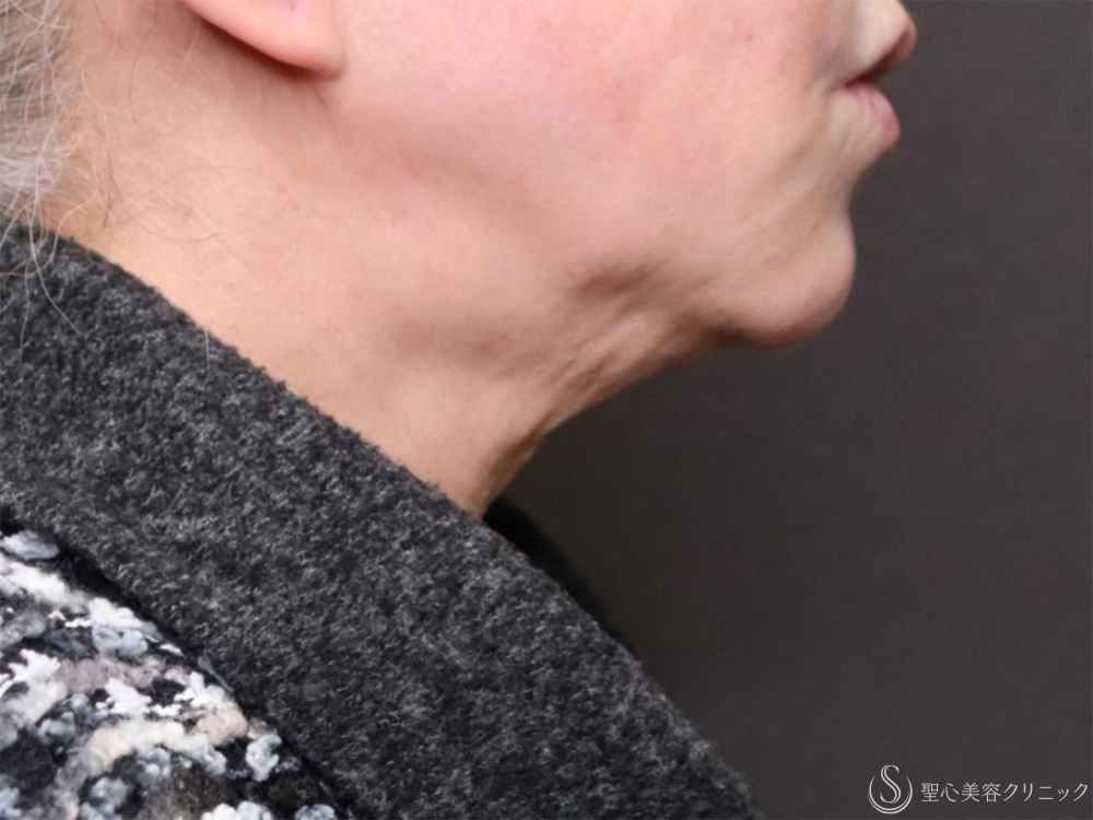 肌育スレッド（フィオラ スレッド PDRN モノ）＋顎ボトックス注入_After