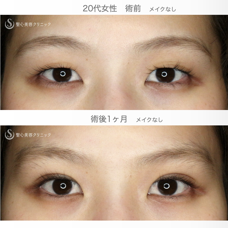 【20代女性・二重埋没で美人度アップ】マイクロメソッド+α「3点留め」（1ヶ月後） After 