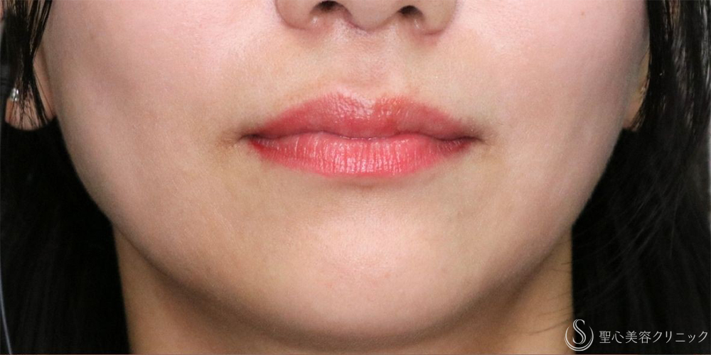 【30代女性・唇のボリュームアップ】唇のヒアルロン酸注入（術後翌日） Before 
