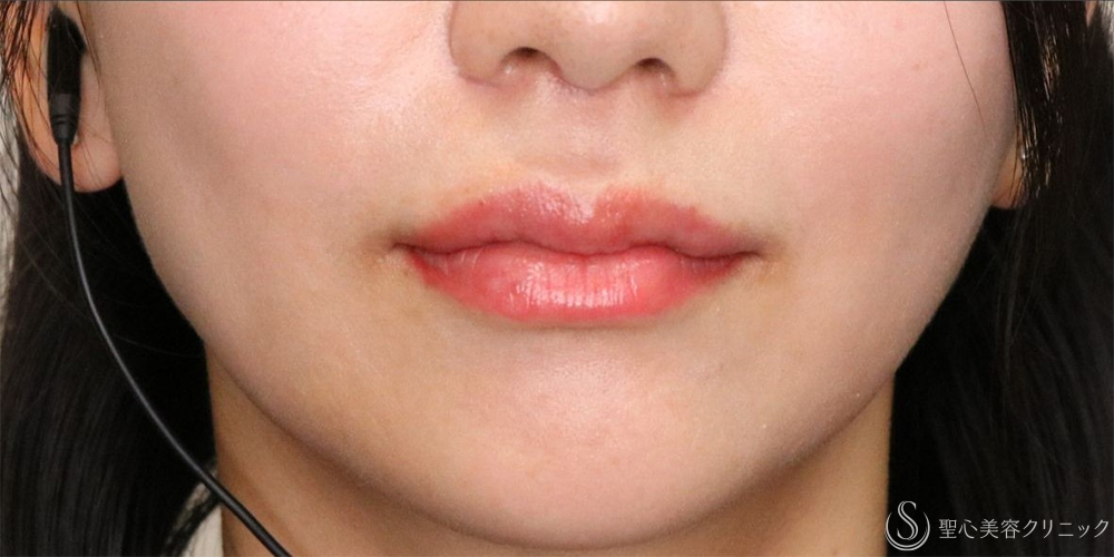 【30代女性・唇のボリュームアップ】唇のヒアルロン酸注入（術後翌日） After 名古屋+ヒアルロン酸注入・スマイルリップ