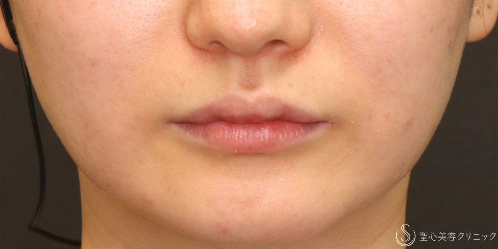 【20代女性・唇のボリュームアップ】唇のヒアルロン酸注入（術後翌日） Before 