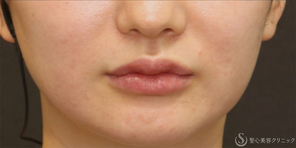 【20代女性・唇のボリュームアップ】唇のヒアルロン酸注入（術後翌日） After 