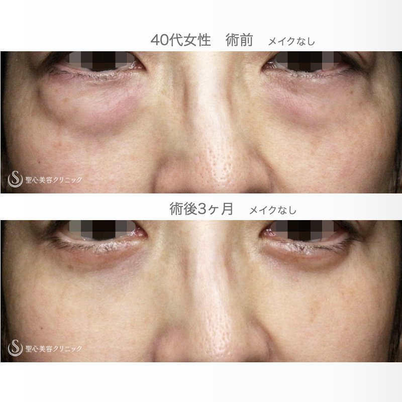 【40代女性・目の下のクマ劇的な若返り】表ハムラ+α法「Ver.3」 単独例（直後〜3ヶ月後） After 