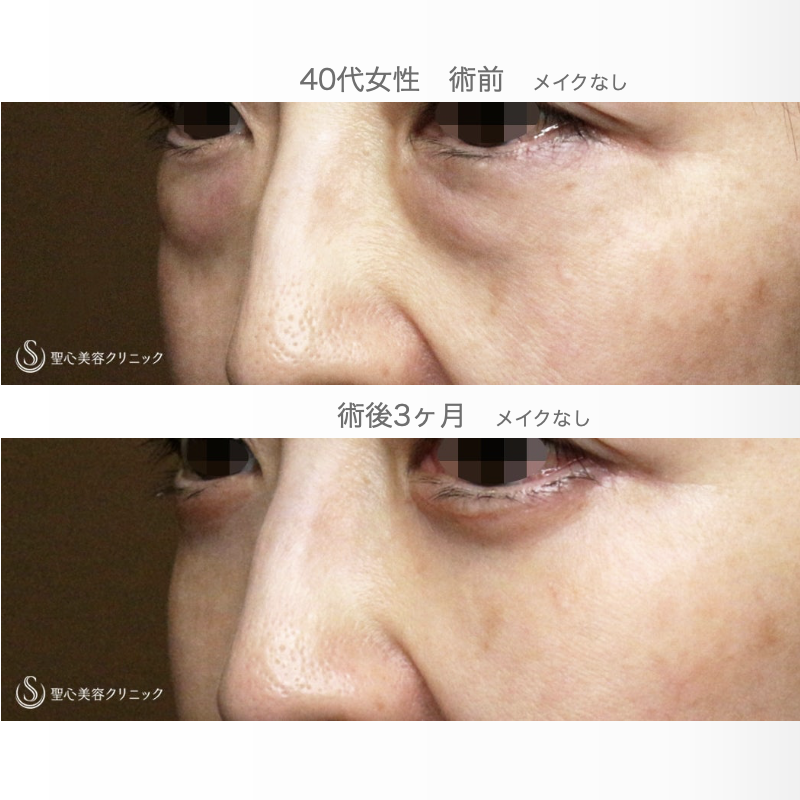 【40代女性・目の下のクマ劇的な若返り】表ハムラ+α法「Ver.3」 単独例（直後〜3ヶ月後） After 