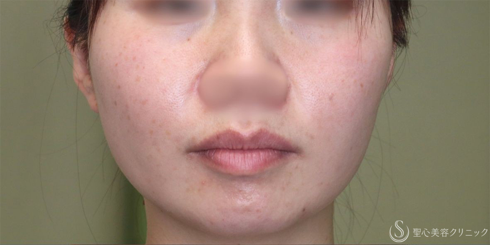 【30代女性・手軽に小顔に】ボツリヌストキシン注入（注射）（エラ）（術後1ヶ月） Before 
